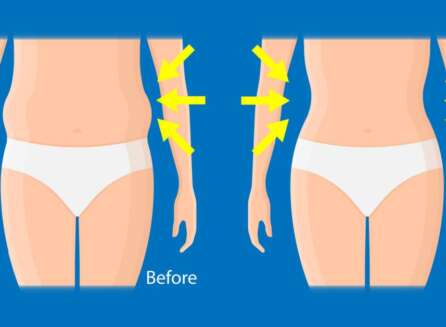 coolsculpting