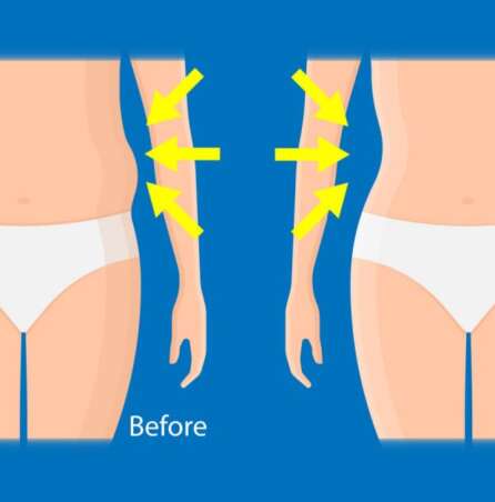 coolsculpting