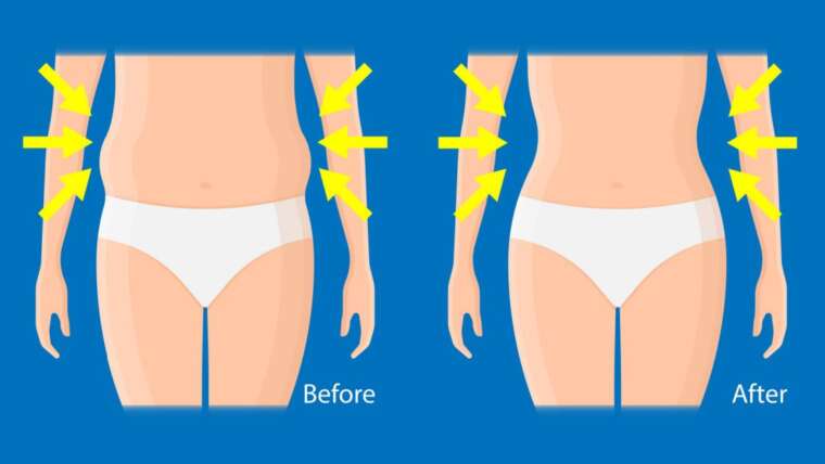 coolsculpting