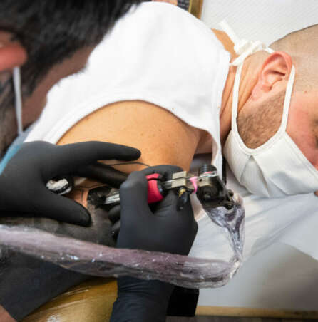 What Happens to Your Skin After Tattoo Removal