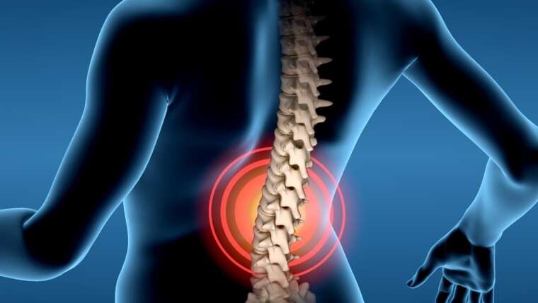lower back pain from epidural years later